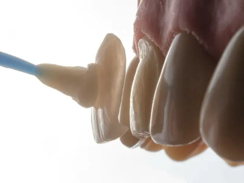 Dental veneers being placed on a tooth model