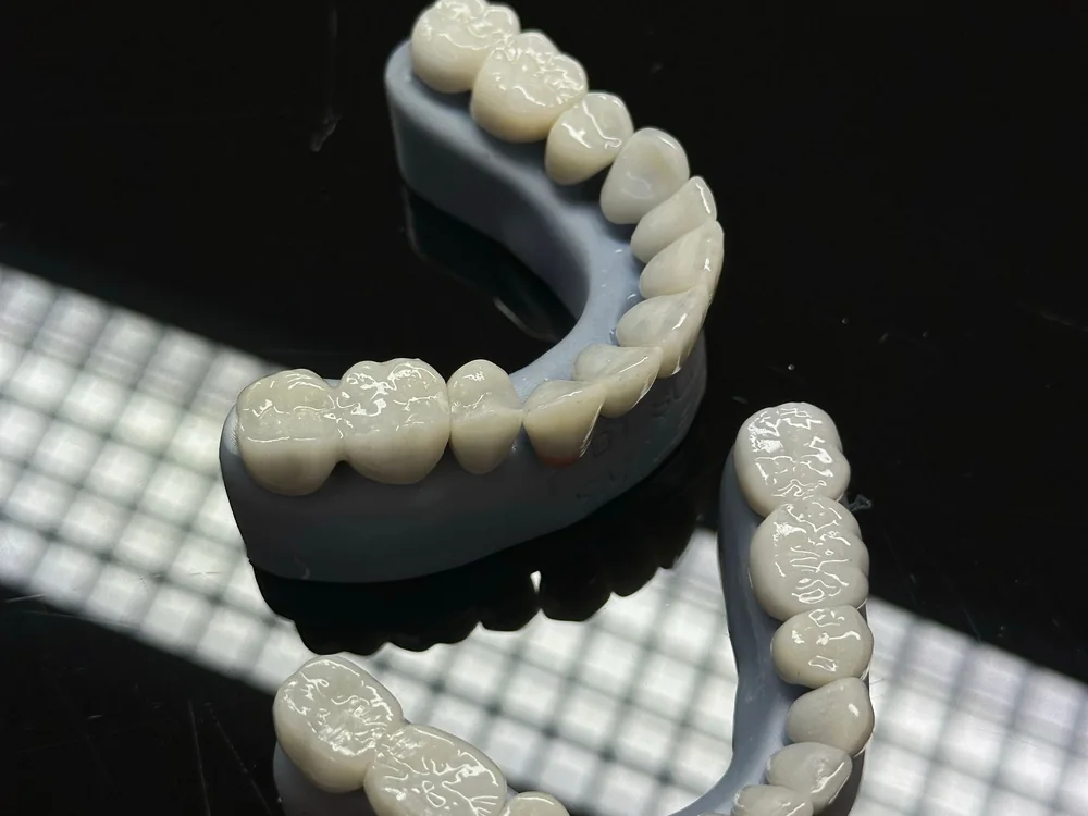 Full-arch dental model with ceramic crowns