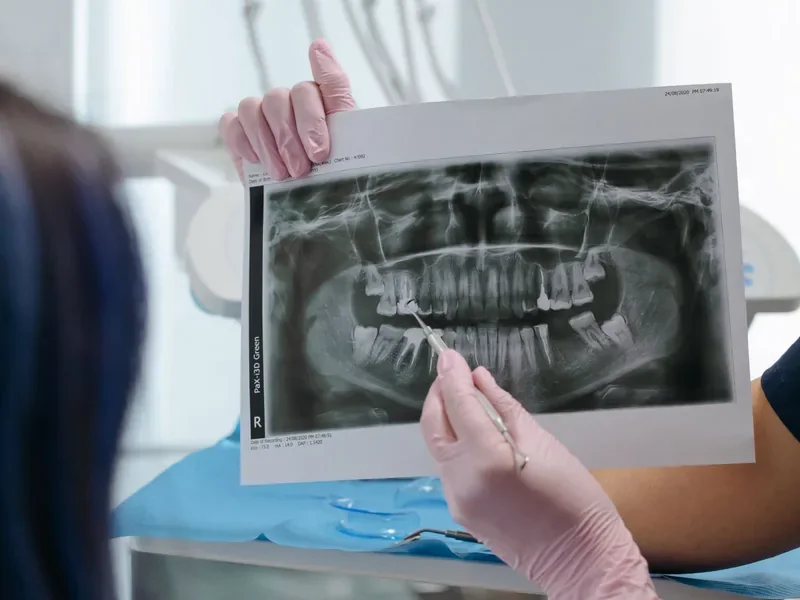Root canal treatment